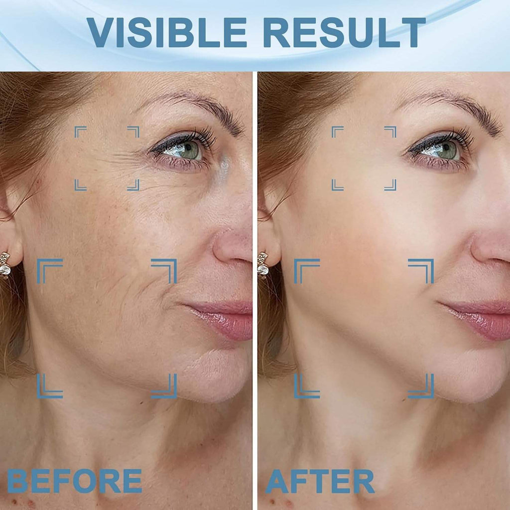 DermaLaser Pro™  Red-Light Laser Therapy Mask